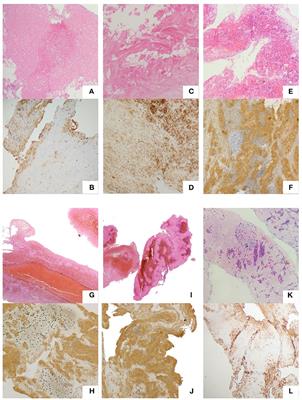 Differences in Pathological Composition Among Large Artery Occlusion Cerebral Thrombi, Valvular Heart Disease Atrial Thrombi and Carotid Endarterectomy Plaques